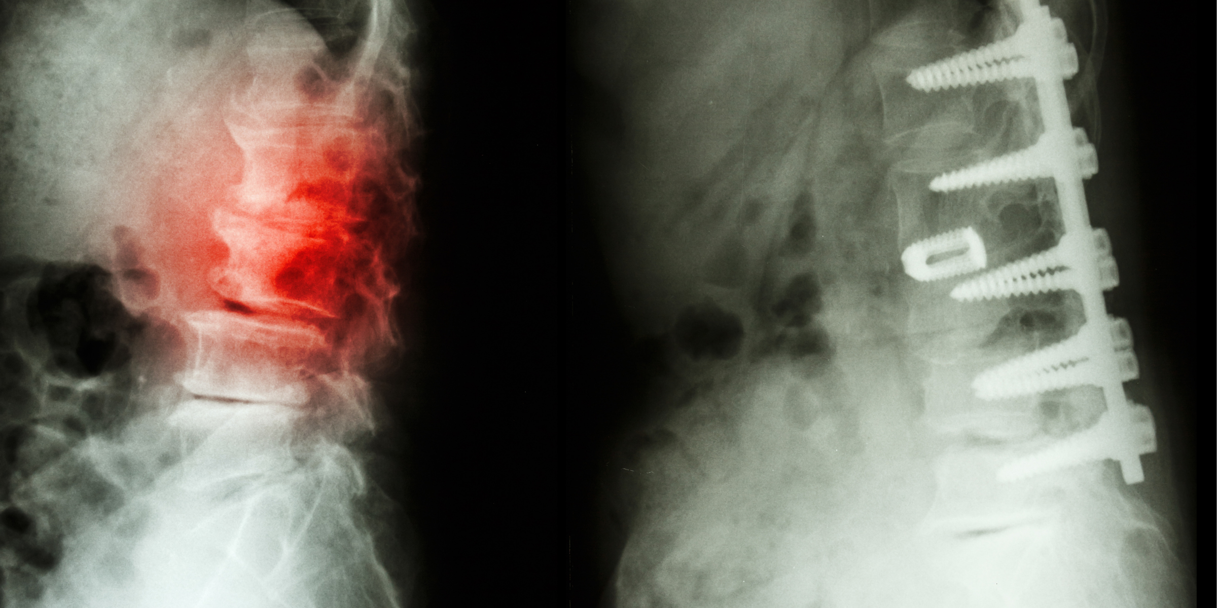 A nyaki gerinc csontritkulásának és artrózisának kezelése